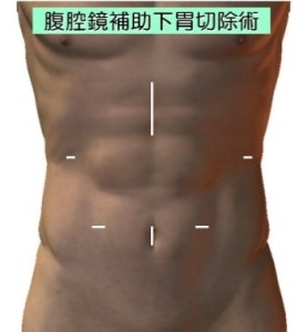 胃がんに対する腹腔鏡手術１