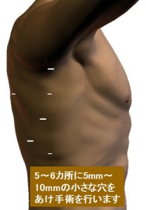胸腔鏡手術