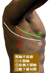 開胸手術