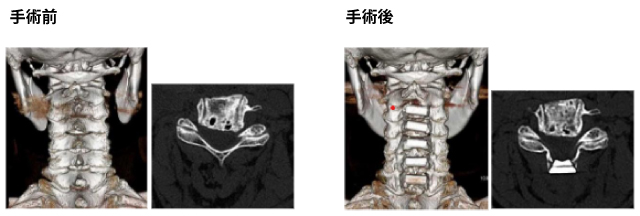 椎弓形成術